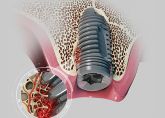       IMPLANT SYSTEM