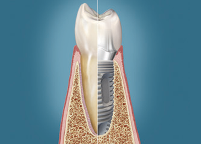 PROSTHETIC CONNECTIONS